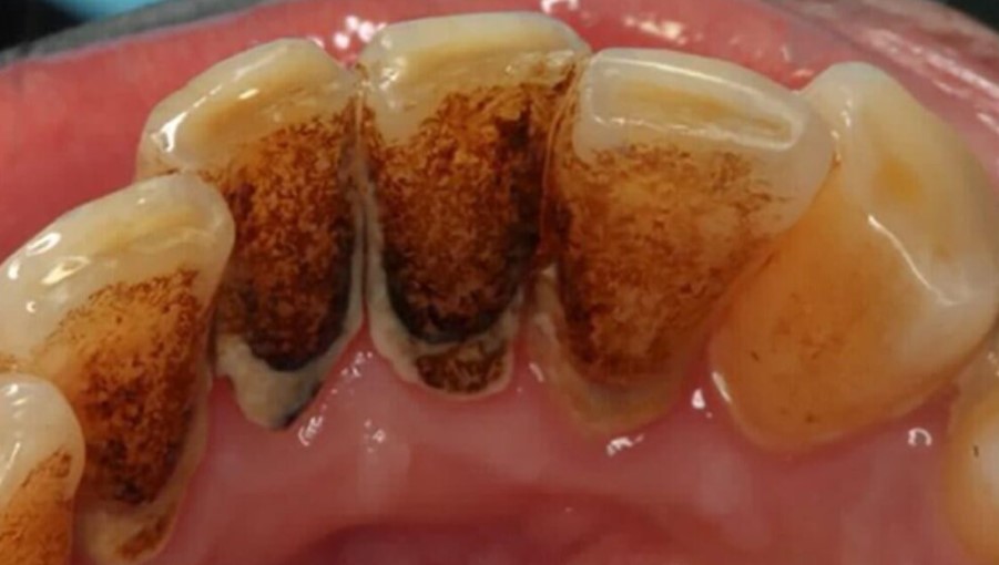 Calculus Bridge, Symptoms, Treatment