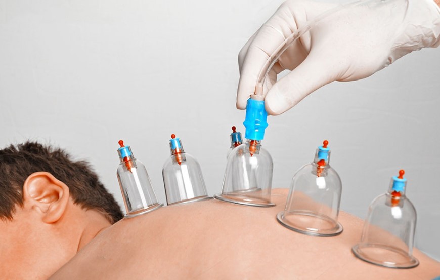 Hijama advantages