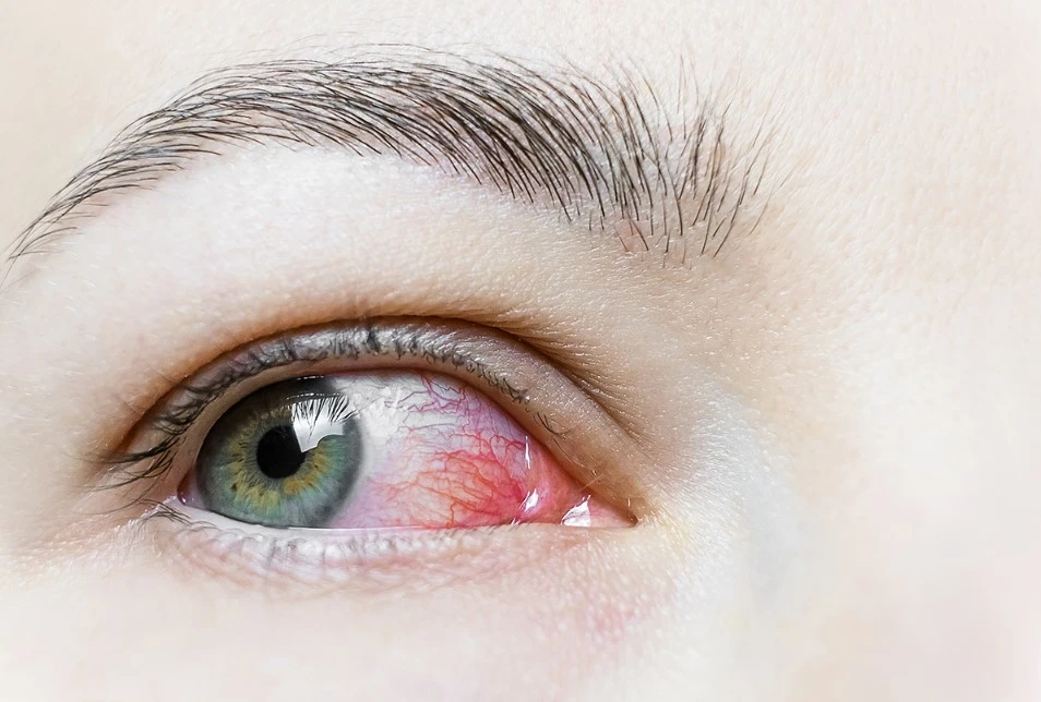 What is Commonly Misdiagnosed As Pink Eye